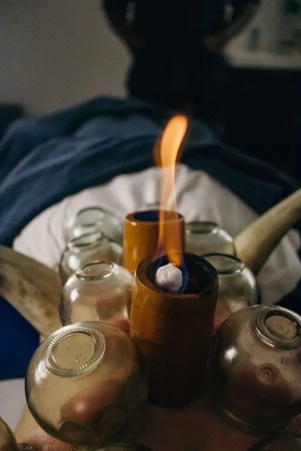Flamme et ventouses en verre prêtes à être posées
