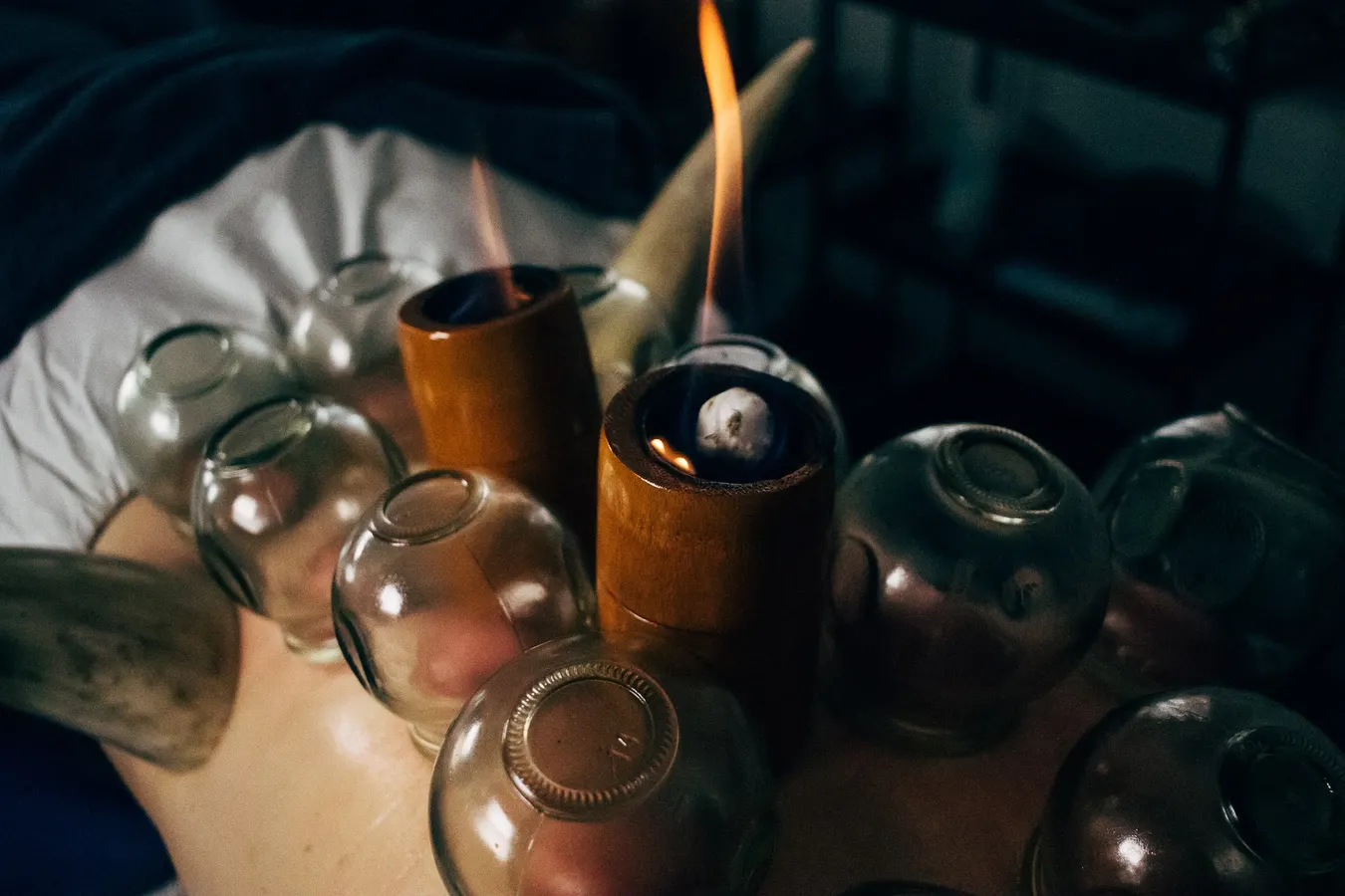 Ventouses et flamme sur le dos