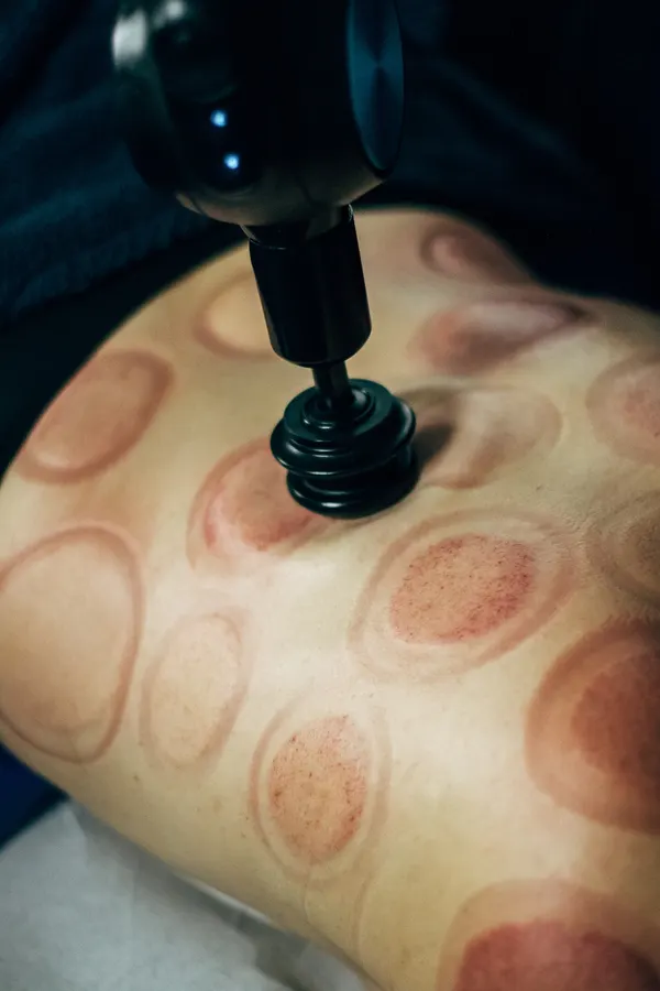 Pistolet de massage sur le dos, marques de ventouses
